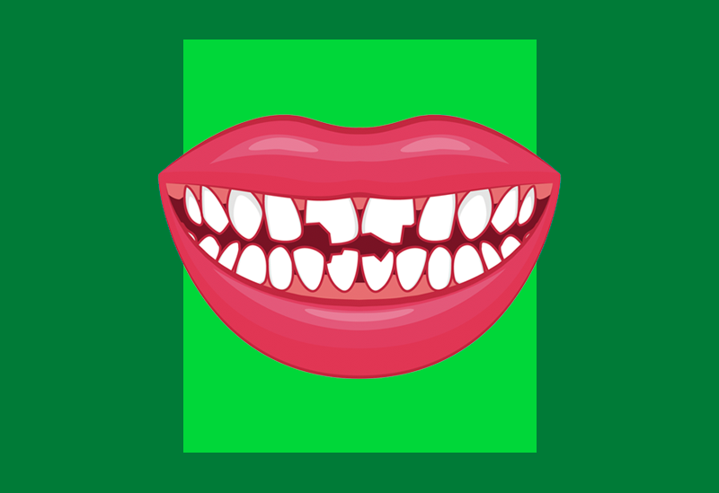boca sorrindo com vários indícios de erosão dental, com dentes fragmentados e danificados