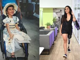 Letícia Silvério, aos sete anos, logo após a descoberta do osteossarcoma; Letícia hoje, aos 30 anos / Foto: Divulgação