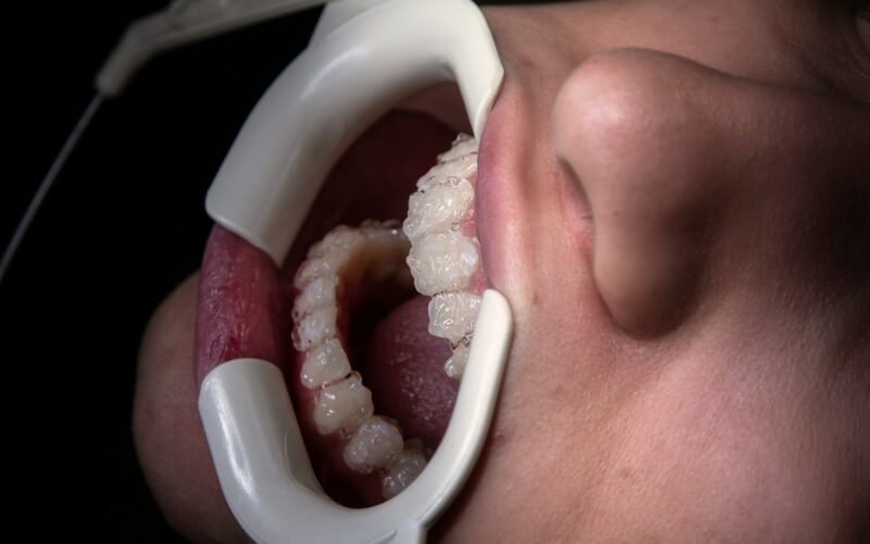 a close up of a person's mouth with a dental device attached to it